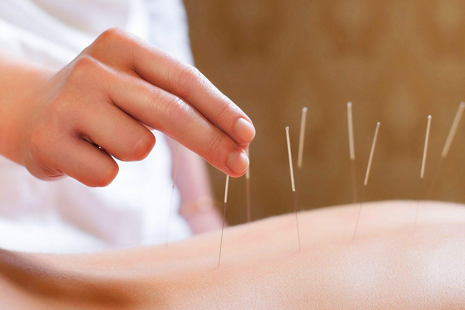 Person performing acupuncture