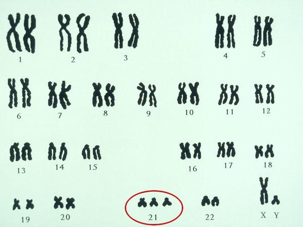 Diagram of down syndrome chromosomes
